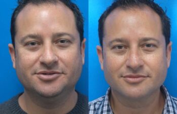 Neck Lift Before and After | Sayah Institute