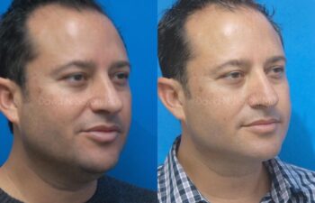 Neck Lift Before and After | Sayah Institute
