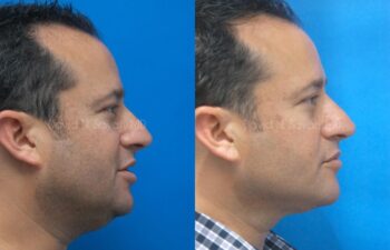 Neck Lift Before and After | Sayah Institute