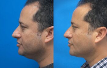 Neck Lift Before and After | Sayah Institute