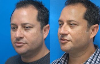 Neck Lift Before and After | Sayah Institute