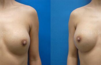 Breast Implant Exchange Before and After | Sayah Institute