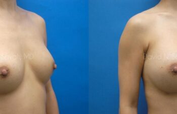 Breast Implant Exchange Before and After | Sayah Institute
