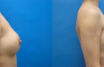 Breast Implant Exchange Before and After | Sayah Institute