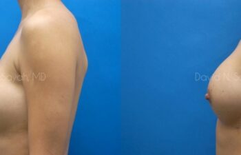 Breast Implant Exchange Before and After | Sayah Institute