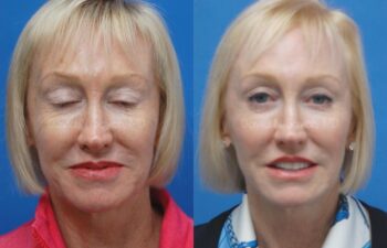 Co2 Laser Before and After | Sayah Institute