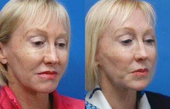 Co2 Laser Before and After | Sayah Institute