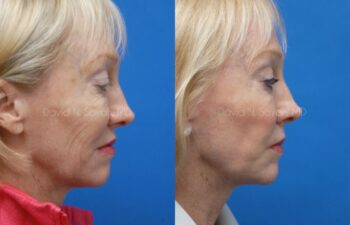 Co2 Laser Before and After | Sayah Institute