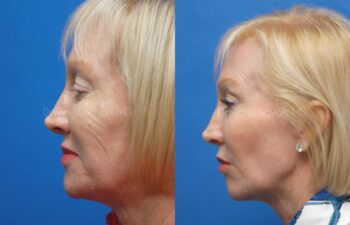 Co2 Laser Before and After | Sayah Institute