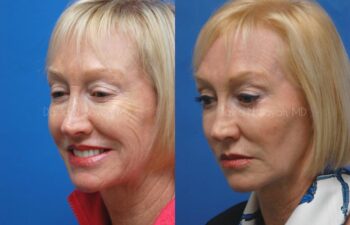 Co2 Laser Before and After | Sayah Institute