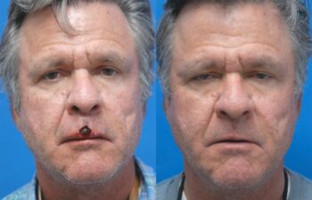 Skin Cancer Reconstruction Before and After | Sayah Institute