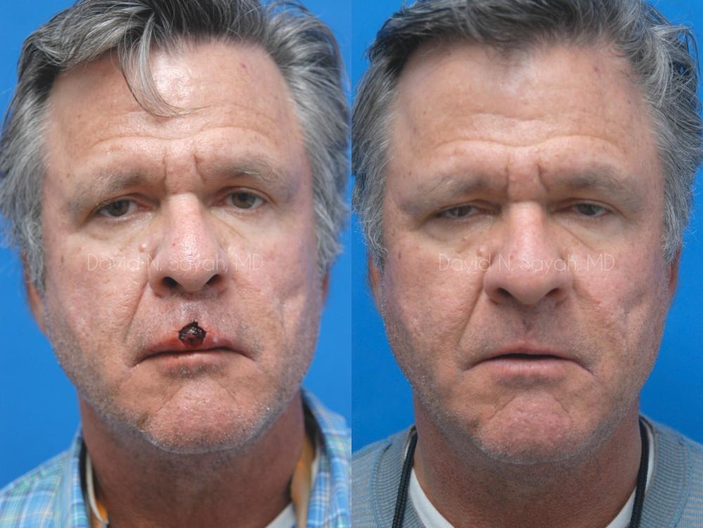 Skin Cancer Reconstruction Before and After | Sayah Institute