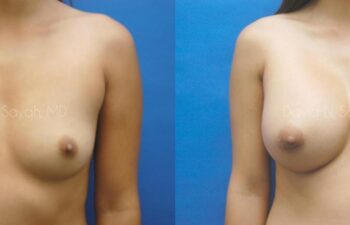 Breast Augmentation Before and After | Sayah Institute