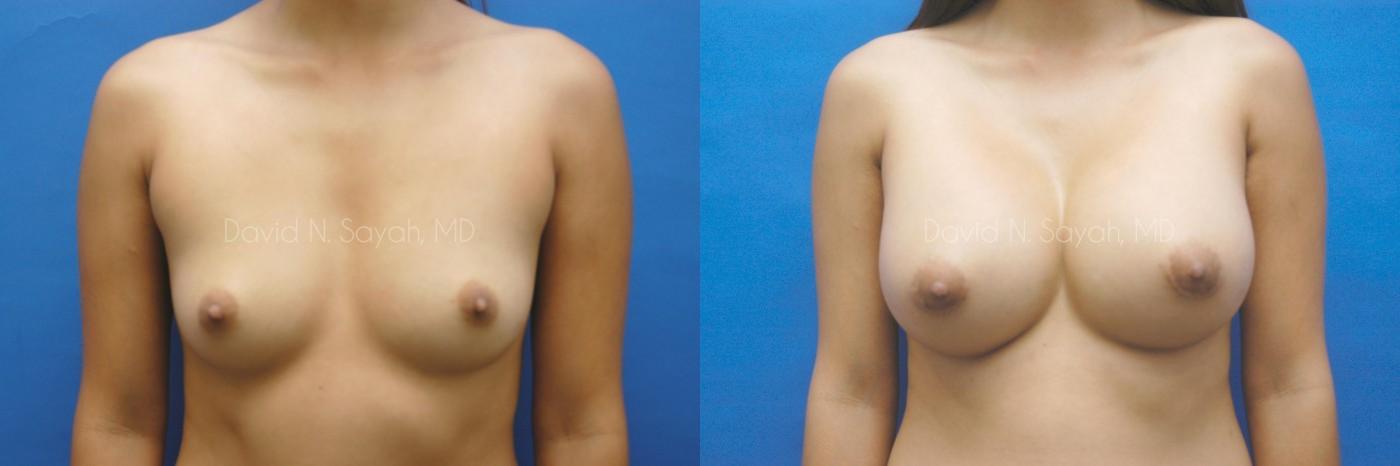 Breast Augmentation Before and After | Sayah Institute