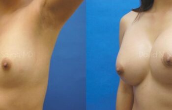 Breast Augmentation Before and After | Sayah Institute