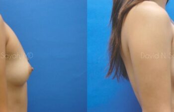 Breast Augmentation Before and After | Sayah Institute