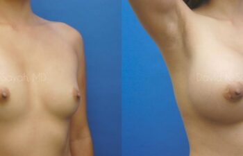 Breast Augmentation Before and After | Sayah Institute