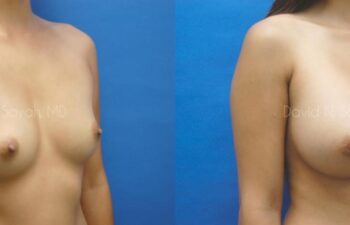 Breast Augmentation Before and After | Sayah Institute