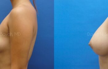 Breast Augmentation Before and After | Sayah Institute