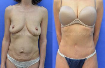 Tummy Tuck Before and After | Sayah Institute