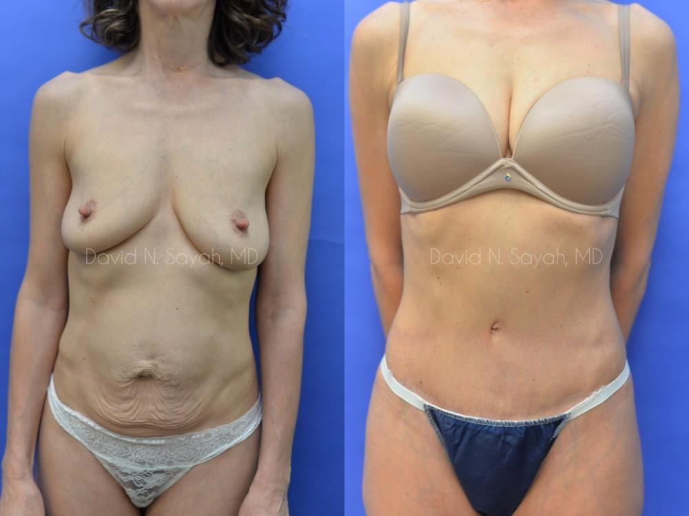 Tummy Tuck Before and After | Sayah Institute