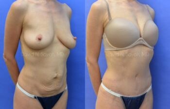 Tummy Tuck Before and After | Sayah Institute