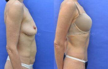 Tummy Tuck Before and After | Sayah Institute