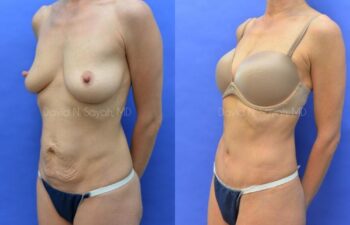 Tummy Tuck Before and After | Sayah Institute