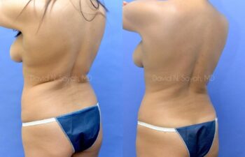 Tummy Tuck Before and After | Sayah Institute