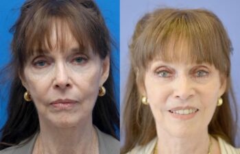 Facelift Before and After | Sayah Institute