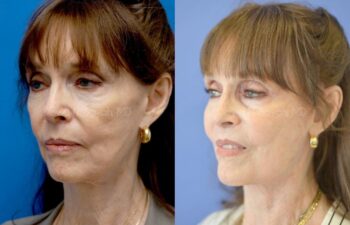 Facelift Before and After | Sayah Institute
