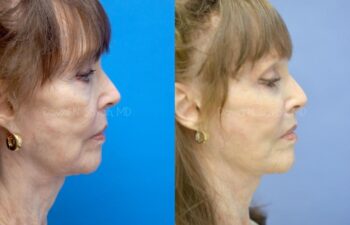 Facelift Before and After | Sayah Institute
