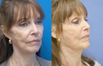 Facelift Before and After | Sayah Institute