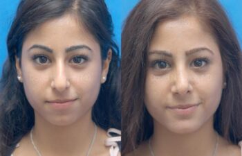 Chin Implant Before and After | Sayah Institute