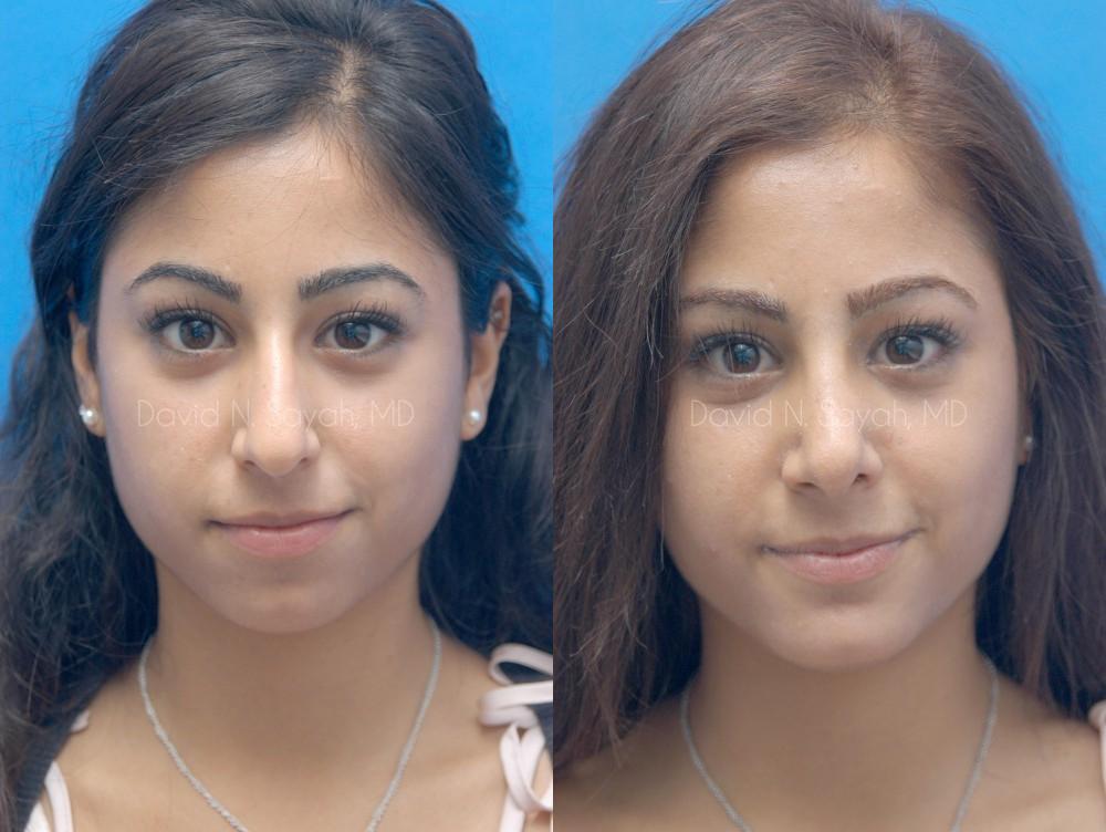 Chin Implant Before and After | Sayah Institute