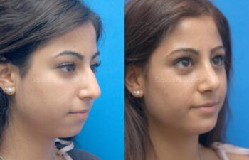 Chin Implant Before and After | Sayah Institute