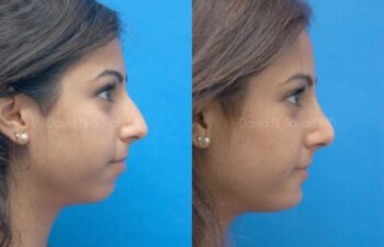 Chin Implant Before and After | Sayah Institute
