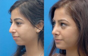 Chin Implant Before and After | Sayah Institute