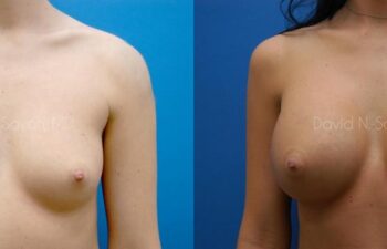 Breast Augmentation Before and After | Sayah Institute
