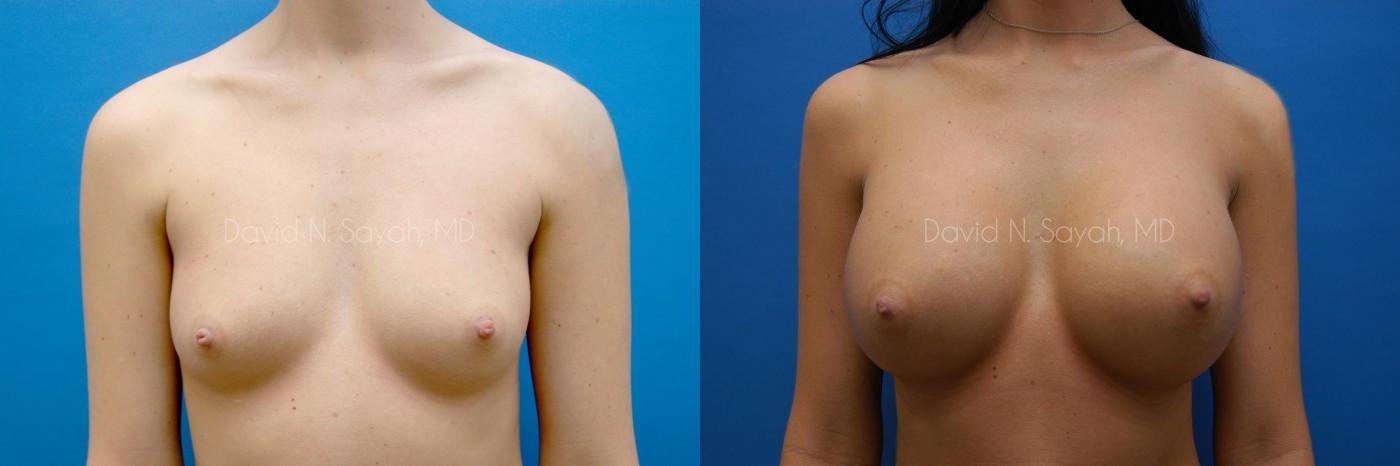 Breast Augmentation Before and After | Sayah Institute