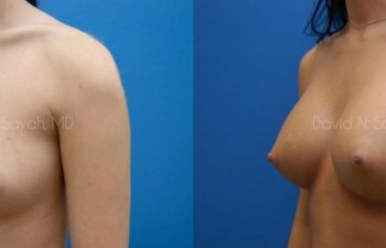 Breast Augmentation Before and After | Sayah Institute