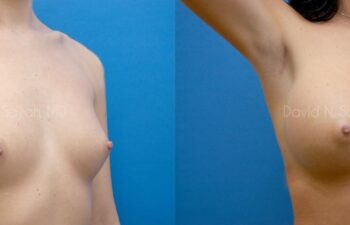 Breast Augmentation Before and After | Sayah Institute