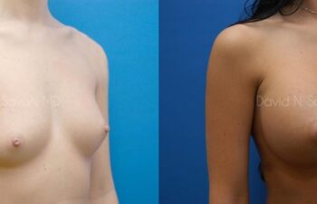 Breast Augmentation Before and After | Sayah Institute