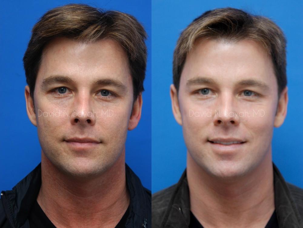 Co2 Laser Before and After | Sayah Institute