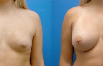 Breast Augmentation Before and After | Sayah Institute