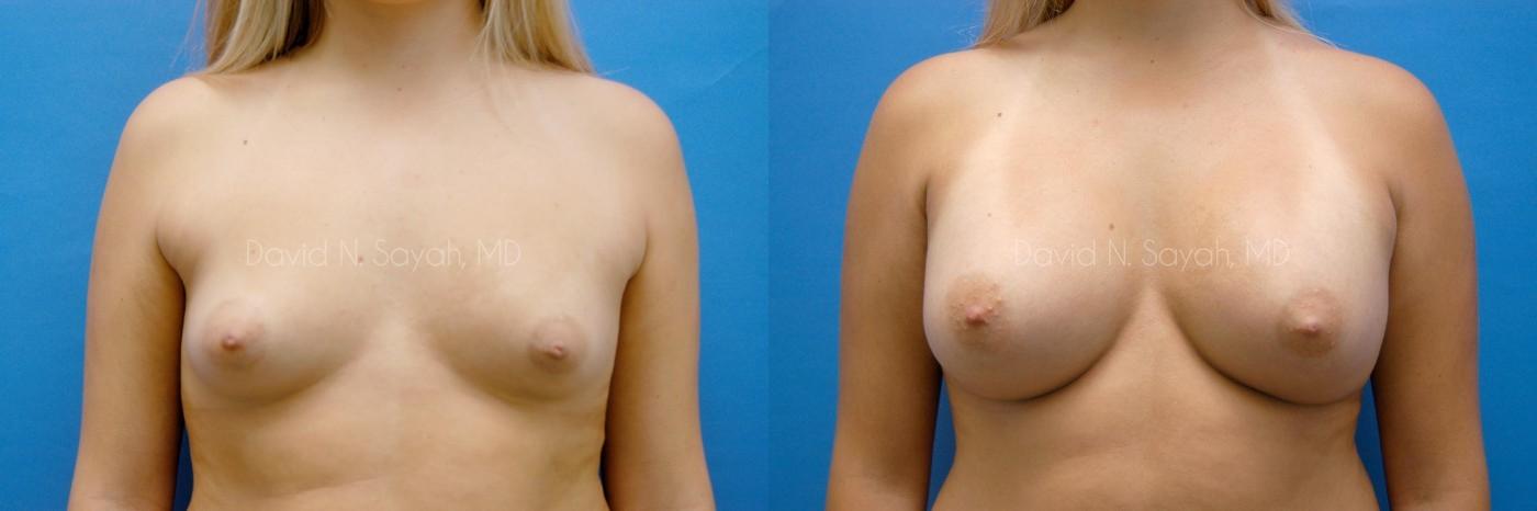 Breast Augmentation Before and After | Sayah Institute