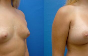 Breast Augmentation Before and After | Sayah Institute