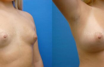 Breast Augmentation Before and After | Sayah Institute
