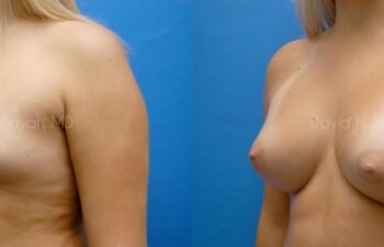 Breast Augmentation Before and After | Sayah Institute