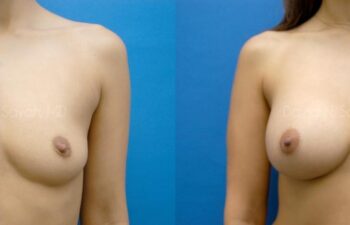 Breast Augmentation Before and After | Sayah Institute